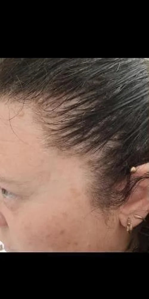 Customer-supplied photograph of the side hairline, before