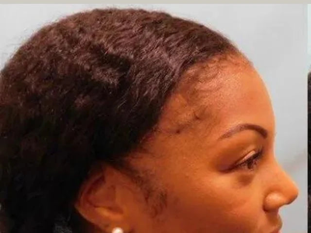 Customer-supplied photograph of the temple and hairline, before