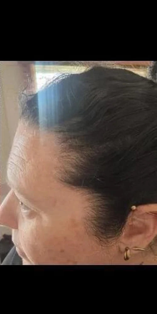 Customer-supplied photograph of the side hairline, after